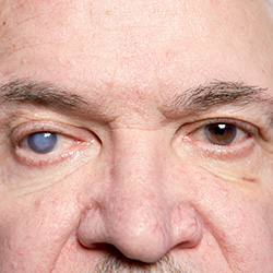 cataract in one eye