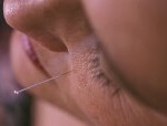 acupuncture