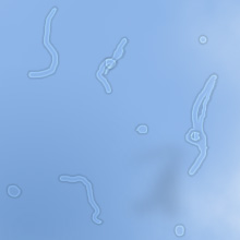 eye floaters caused by protein and other debris