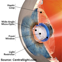 centrasight implantable telescope AMD