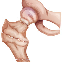 hip fracture