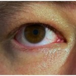 red-eyes