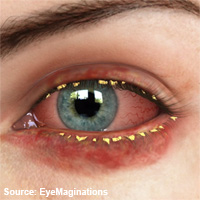 blepharitis-200
