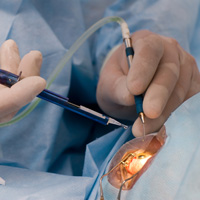 cataract surgery