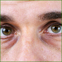dark circles under eyes
