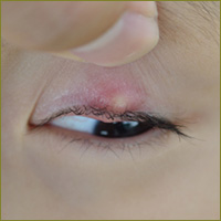 A stye on the eyelid edge may look like a pimple 