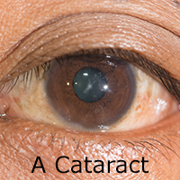 cataracts