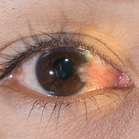 Pterygium surfer's eye injury