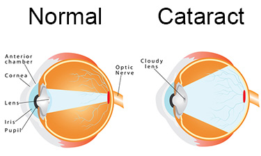 eyeball normal vs cataract lens