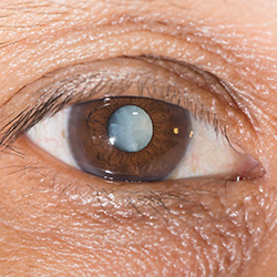 prevent cataracts