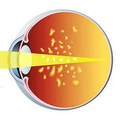 vitreous floaters