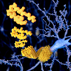 amyloid plaques