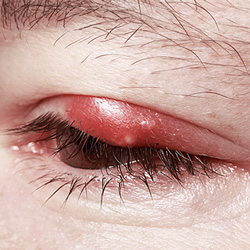 eyelid