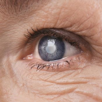 cataract needs antioxidants