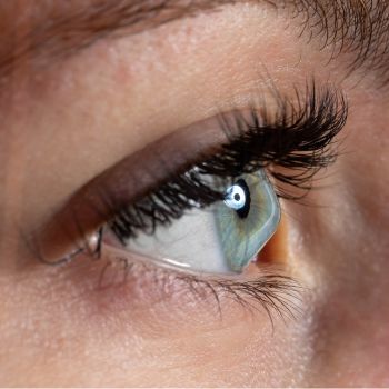 An eye that has a bulging cornea, due to keratoconus