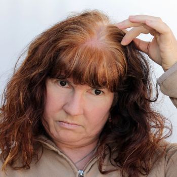 Hair loss and eye conditions can have common roots.